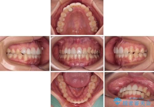 前歯のデコボコが気になる インビザラインによる矯正治療の治療中