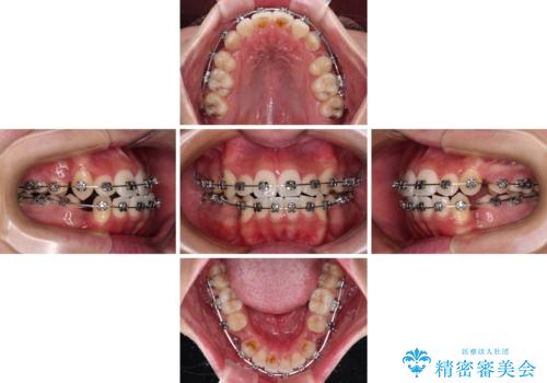 上下の八重歯とクロスバイト　ワイヤー装置での抜歯矯正の治療中