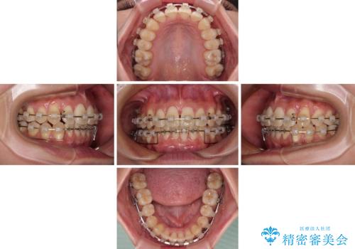 前に飛び出した上顎前歯をスッキリと引っ込める ワイヤー装置での矯正治療の治療中