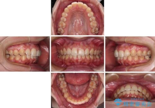前歯のデコボコをインビザライン矯正で綺麗に改善の治療中