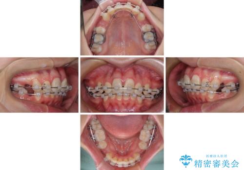 指が入るくらいに隙間のある上下前歯　抜歯矯正で横顔の印象が大きく改善の治療中