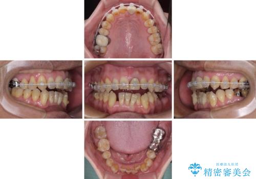 外科手術を検討? 過大な開咬をワイヤー装置とインビザラインで劇的に改善するの治療中