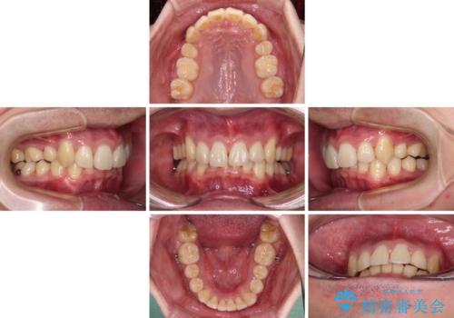 八重歯の抜歯矯正 インビザラインを用いて気になる歯並びを改善の治療中