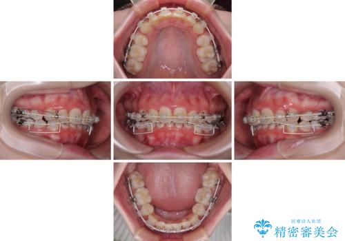 叢生・ディープバイト・突出 ワイヤー装置での抜歯矯正で全てを解決の治療中