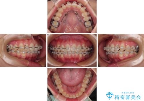 デコボコをワイヤー装置で改善 短期間で綺麗な仕上がりにの治療中