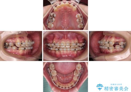 八重歯と正中のズレ　ワイヤー装置での抜歯矯正の治療中