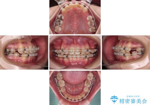 八重歯と正中のズレ ワイヤー装置での抜歯矯正の治療中