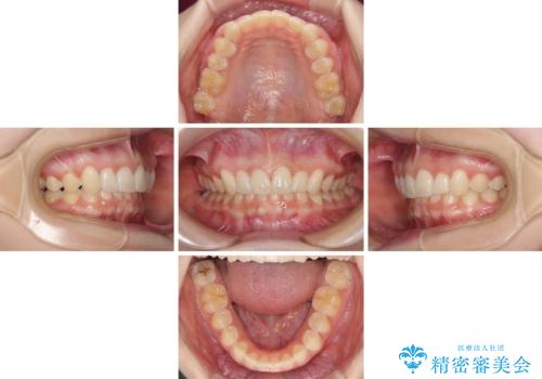 前歯のデコボコを治したい インビザライン矯正治療の治療中