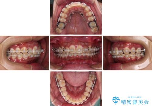 上顎前突とディープバイト ワイヤー矯正での確実に仕上げるの治療中