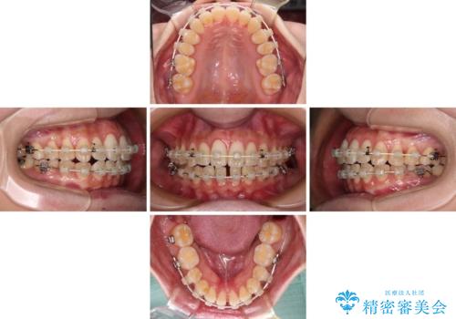 下顎前歯の欠損歯列 ワイヤー装置での矯正治療の治療中