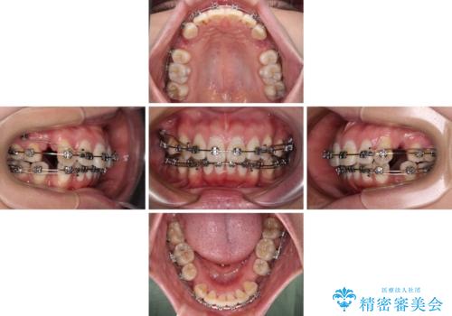 上顎前突で口が閉じにくい ワイヤー装置での抜歯矯正の治療中
