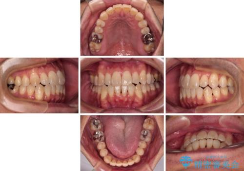 40代男性 今からでも遅くない インビザラインで綺麗な歯列を獲得の治療中