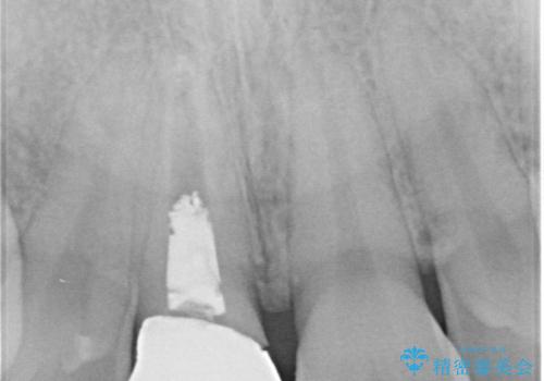 【オールセラミッククラウン】前歯の見た目が気になる!の治療前