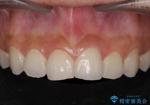 すり減った前歯の形態回復の症例 治療後