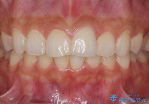 すり減った前歯の形態回復の治療後