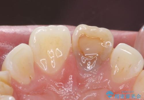 変色した前歯 ジルコニアクラウンでの修復の治療前