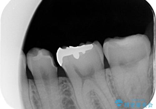 【セラミックインレー】詰め物が外れたので、ついでに白くしたいの治療前