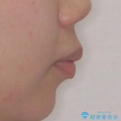 上顎前突で口が閉じにくい ワイヤー装置での抜歯矯正の治療前(顔貌)