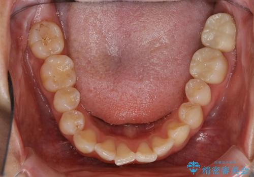 保険治療のプラスチックが劣化し虫歯に。　セラミックでつぎはぎなく治療の治療後
