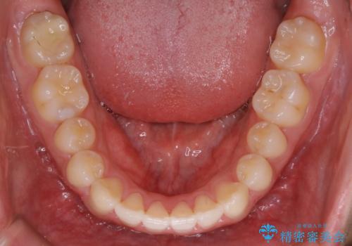 インビザライン矯正 過去に矯正治療したが、また前歯にがたつきがでてきて治したいの治療後