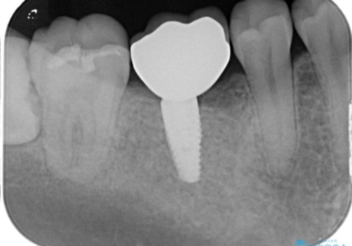 失ったままの臼歯　インプラントによる治療の症例 治療後