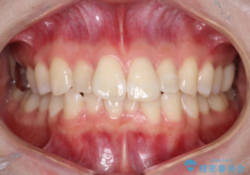 前歯のガタつきをマウスピース矯正で改善の症例 治療前