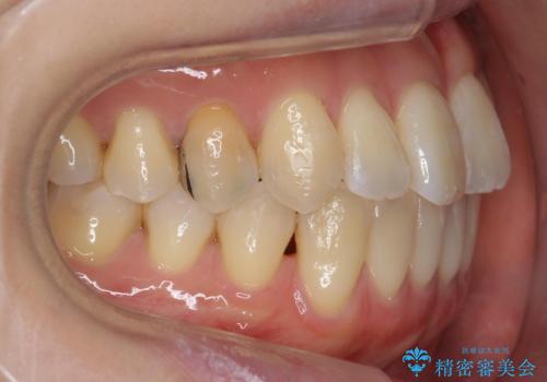 前歯のがたつき 若干受け口 インビザラインでの治療後