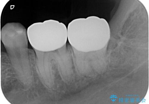 保険治療のプラスチックが劣化し虫歯に。 セラミックでつぎはぎなく治療の治療後