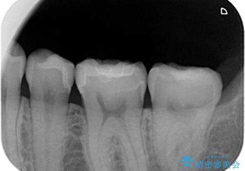 【セラミックインレー】詰め物が外れたので、ついでに白くしたいの治療後