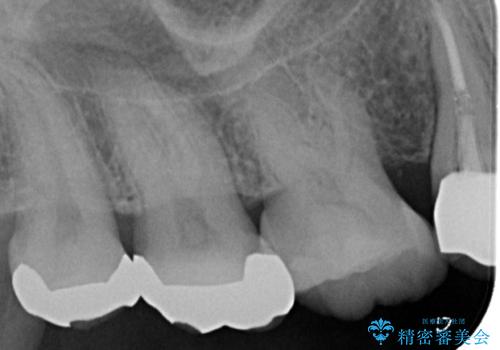 歯が折れている(1DAY インプラント)の治療前