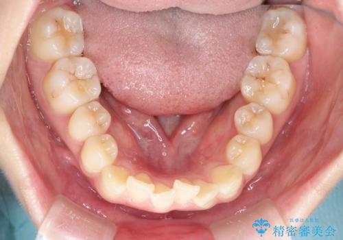 前歯のガタつきをマウスピース矯正で改善の治療前