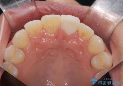すり減った前歯の形態回復の治療後