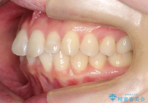 前歯のガタつきをマウスピース矯正で改善の治療前