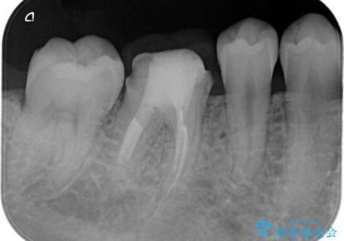 【根管治療】ラバーダムと顕微鏡を用いた治療の治療中