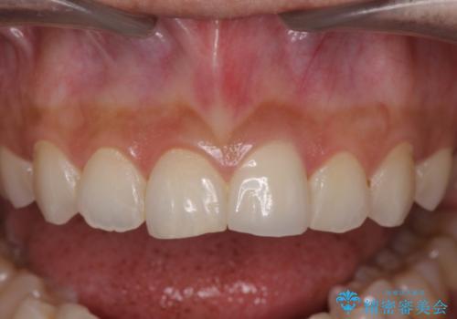 すり減った前歯の形態回復の治療後