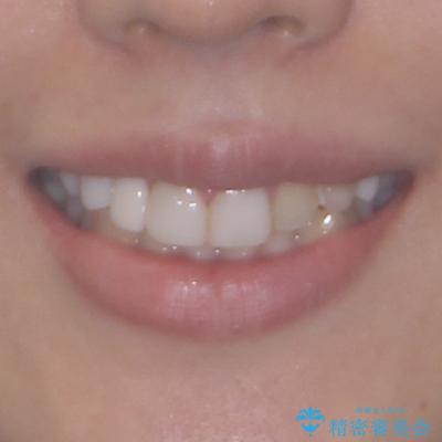 前歯のデコボコが気になる インビザラインによる矯正治療の治療前(顔貌)