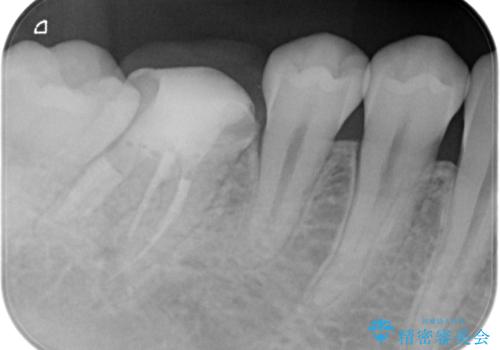 【根管治療】ラバーダムと顕微鏡を用いた治療の治療中