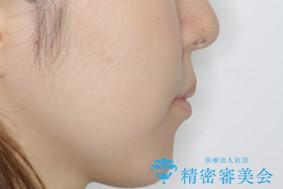 本来は外科ケース:インビザラインで前歯の重度がたつきとオープンバイトの改善の治療後(顔貌)