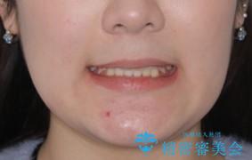 出っ歯と深い噛み合わせ:抜歯矯正で口元スッキリ!の治療後(顔貌)