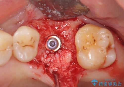 失った咬合機能の回復 インプラント治療の治療中