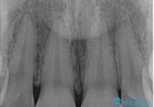 すり減った前歯の形態回復の治療前