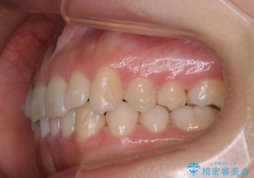 インビザライン矯正　短期間でがたつきのないきれいな歯並びにの治療中