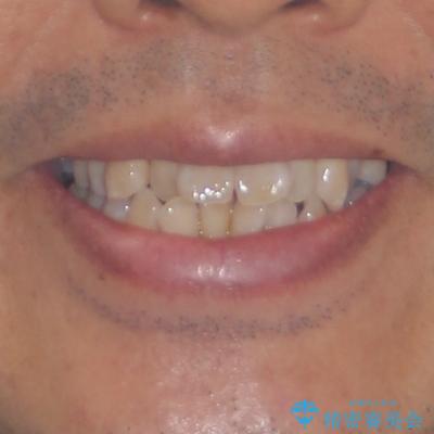 40代男性 今からでも遅くない インビザラインで綺麗な歯列を獲得の治療前(顔貌)