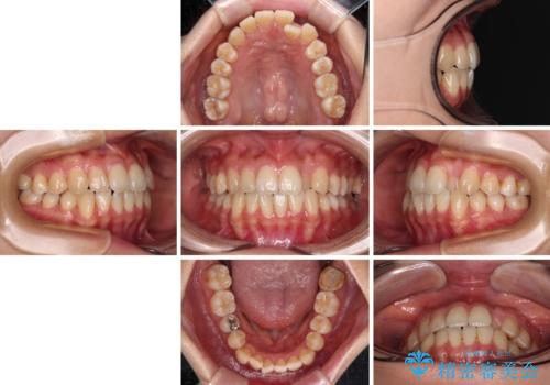 クロスバイトの前歯を改善　ワイヤー装置で楽々矯正治療の治療前