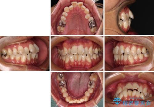 40代男性 今からでも遅くない インビザラインで綺麗な歯列を獲得の治療前