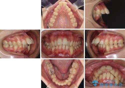 出っ歯を治したい ワイヤー装置での抜歯矯正で劇的変化!の治療前