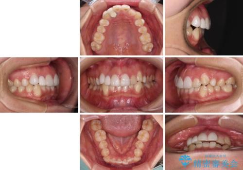 前歯のデコボコが気になる インビザラインによる矯正治療の治療前