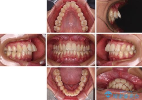 前に飛び出した上顎前歯をスッキリと引っ込める ワイヤー装置での矯正治療の治療前