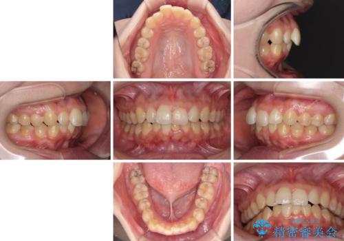 前歯のデコボコをインビザライン矯正で綺麗に改善の治療前