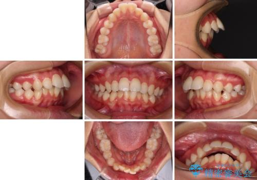 指が入るくらいに隙間のある上下前歯 抜歯矯正で横顔の印象が大きく改善の治療前